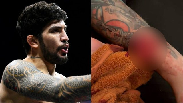 不适画面 | Dillon Danis 分享了迫使 Mike Perry 退赛的伤势惨状。